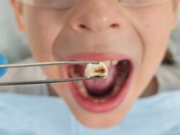 Best Emergency Tooth Extraction in Dover, DE